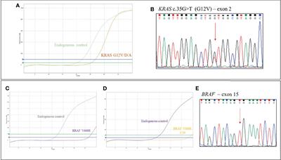 Concurrent RAS and RAS/BRAF V600E Variants in Colorectal Cancer: More Frequent Than Expected? A Case Report